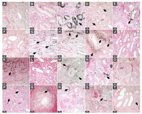 Figure 1. von Kossa staining of human kidney tissues. Kidney tissues were processed for von Kossa staining as described in Methods. Positive staining was based on the observation of black precipitates under optical microscopy (black arrows). Tissues in (A,B) consist of healthy controls; (C,D) correspond to patients with end-stage kidney disease; (E–T) tissues from renal cancer patients. Tissues from two additional cases of renal cancer are shown in Fig. 2. Scale bars: 10μm. Figure 1. von Kossa staining of human kidney tissues. Kidney tissues were processed for von Kossa staining as described in Methods. Positive staining was based on the observation of black precipitates under optical microscopy (black arrows). Tissues in (A,B) consist of healthy controls; (C,D) correspond to patients with end-stage kidney disease; (E–T) tissues from renal cancer patients. Tissues from two additional cases of renal cancer are shown in Fig. 2. Scale bars: 10μm.