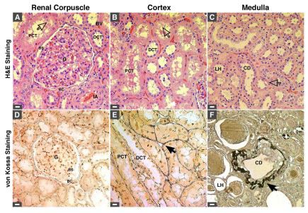 Figure 2. Mineral deposits found in diseased human kidneys. (A–C) H&E staining of human kidney tissues obtained from renal cancer patients. Hollow arrows indicate areas with cellular damage. (D–F) von Kossa staining of human kidney tissues. Mineral precipitates indicated by black arrows were found in the cortex (E) and medulla (F) but were absent in the renal corpuscle (D). Ectopic mineralization was found mainly in the basal membrane and interstitium surrounding the PCT, DCT, LH, and CD. Abbreviations: BC, Bowman's capsule; BS, Bowman's space; BV, blood vessel; CD, collecting duct; DCT, distal convoluted tubule; G, glomerulus; IA, interlobular artery; LH, loop of Henle; PCT, proximal collecting tubule. Scale bars: 10μm. Figure 2. Mineral deposits found in diseased human kidneys. (A–C) H&E staining of human kidney tissues obtained from renal cancer patients. Hollow arrows indicate areas with cellular damage. (D–F) von Kossa staining of human kidney tissues. Mineral precipitates indicated by black arrows were found in the cortex (E) and medulla (F) but were absent in the renal corpuscle (D). Ectopic mineralization was found mainly in the basal membrane and interstitium surrounding the PCT, DCT, LH, and CD. Abbreviations: BC, Bowman's capsule; BS, Bowman's space; BV, blood vessel; CD, collecting duct; DCT, distal convoluted tubule; G, glomerulus; IA, interlobular artery; LH, loop of Henle; PCT, proximal collecting tubule. Scale bars: 10μm.